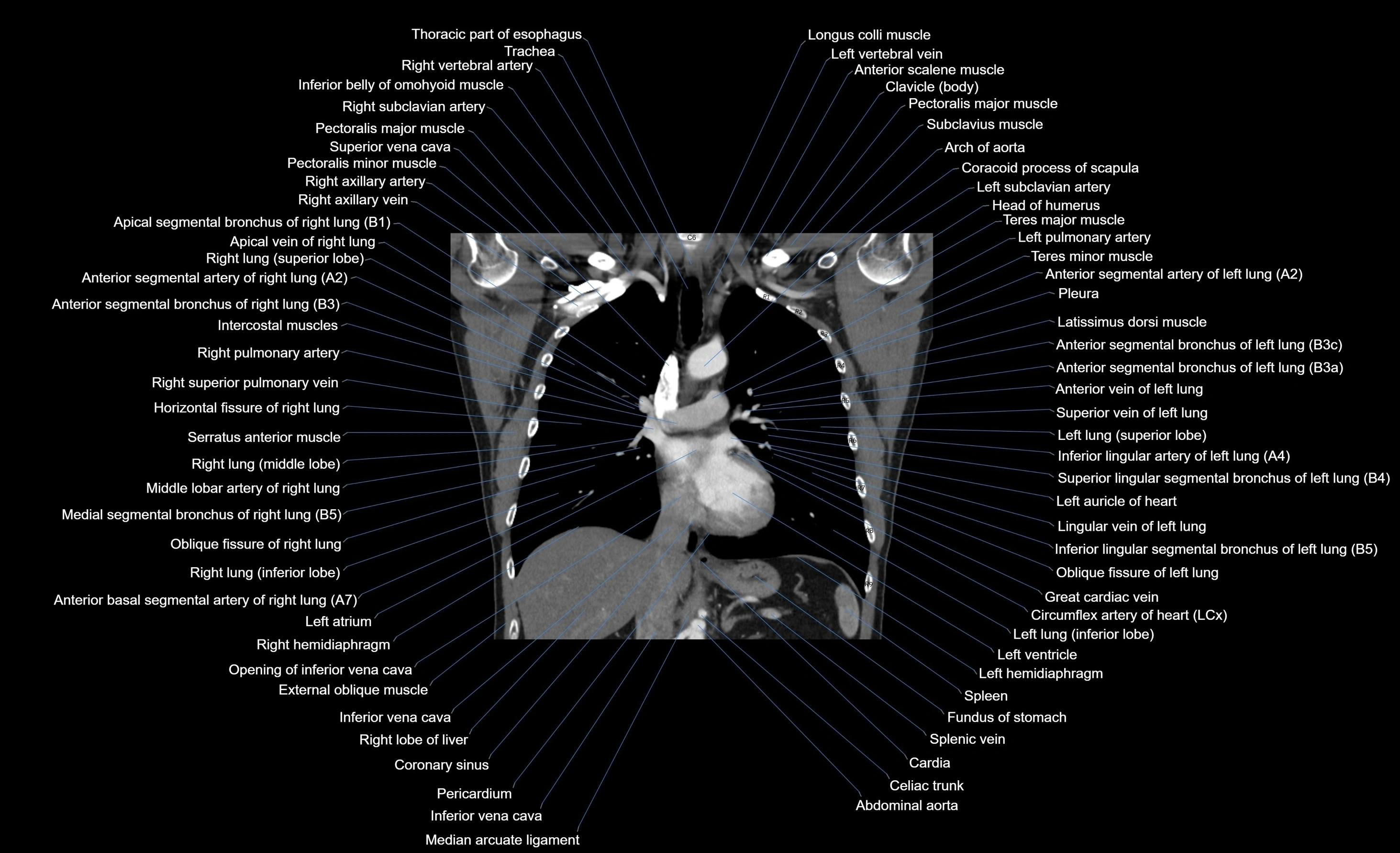 CT chest (thorax) soft tissue window labelled coronal cross sectional anatomy radiology image-00063.webp